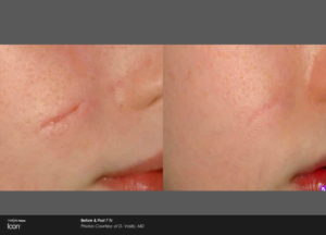 Scar Removal Before and After Images 2