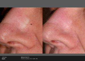 Scar Removal Before and After Images 3