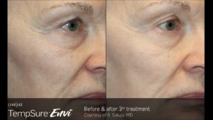 TempSure Envi Before and After Image 8