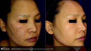 Melasma Treatment Before and After Image 3