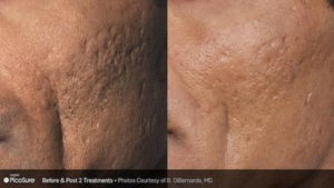 PicoSure Treatment Before and After Photo 1